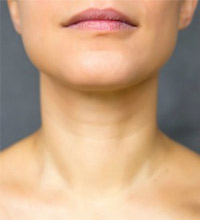 Five Common Myths About Chin Implants