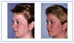 Chin Implant