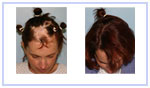 Hair Reconstructive Scalp
