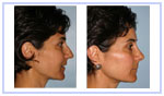 Rhinoplasty