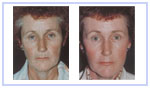 Skin Resurfacing