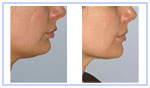 Sub Mental Liposuction