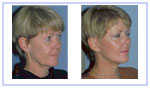Blepharoplasty