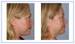 Cheek Implant