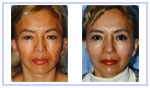 Chemical Resurfacing