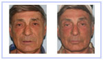 Direct Excision Of Neck Skin