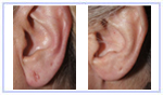 Earlobe Repair