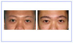 Hair Eyebrow Transplant