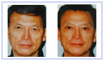 Asian Eyelid