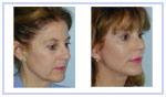 Facelift