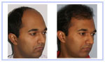 Follicular Unit Hair Grafting