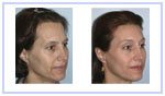 Hair Line Lowering