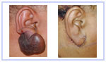 Keloid Removal