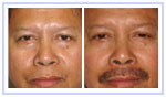 Hair Mustache Transplant