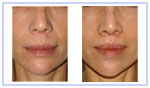 Subnasal Lip Lift