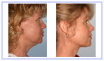Neck Lift