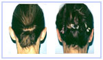 Otoplasty