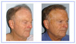 Repair of prior hair plug cases