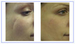 Scar Revision