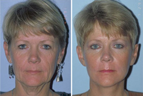 Before and After Facelift Before and After Facelift
