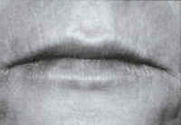 After Laser Resurfacing