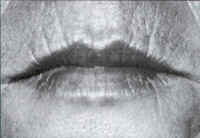 Before Laser Resurfacing