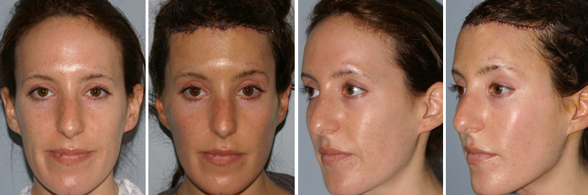 Hairline Lowering Results One Day After Procedure Hairline Lowering Results One Day After Procedure