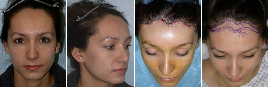 Patient with a high (7.5 cm) hairline Patient with a high (7.5 cm) hairline