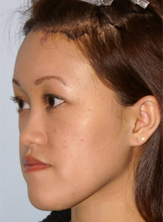 Asian Forehead Reduction - Patient 2 - Obl Left - After