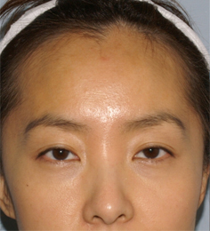 Asian Forehead Reduction - Patient 4 - Front - Before