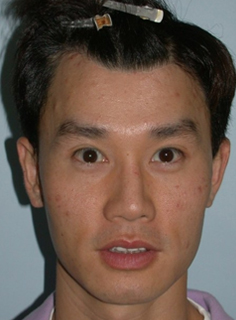 Asian Forehead Reduction - Patient 6 - Front - After
