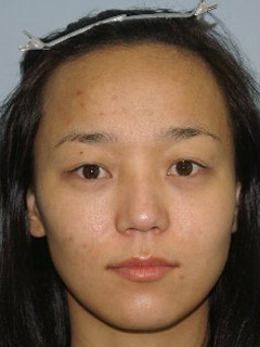 Asian Forehead Reduction - Patient 1 - Front - Before