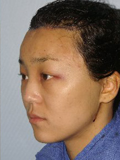 Asian Forehead Reduction - Patient 1 - Obl Left - After