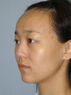 Asian Forehead Reduction - Patient 1 - Obl Left - Before