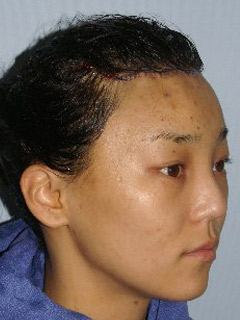 Asian Forehead Reduction - Patient 1 - Obl Right - After
