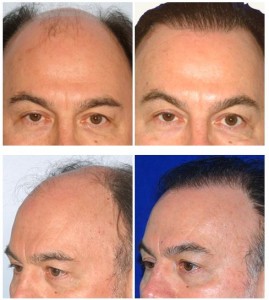 Hair Line Patient