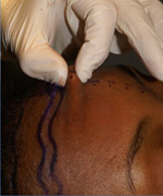 Scalp Laxity - OAK - CA