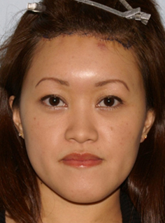 Asian Forehead Reduction - Patient 2 - Front - After Asian Forehead Reduction - Patient 2 - Front - After