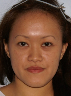 Asian Forehead Reduction - Patient 2 - Front - Before