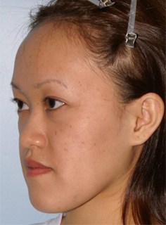 Asian Forehead Reduction - Patient 2 - Obl Left - Before Asian Forehead Reduction - Patient 2 - Obl Left - Before