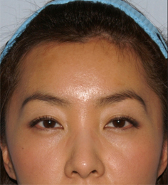 Asian Forehead Reduction - Patient 4 - Front - After Asian Forehead Reduction - Patient 4 - Front - After