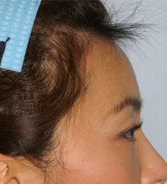 Asian Forehead Reduction - Patient 4 - Lateral Right - After