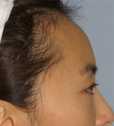Asian Forehead Reduction - Patient 4 - Lateral Right - Before