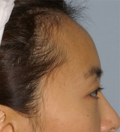 Asian Forehead Reduction - Patient 4 - Lateral Right - Before Asian Forehead Reduction - Patient 4 - Lateral Right - Before