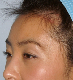 Asian Forehead Reduction - Patient 4 - Obl Left - After