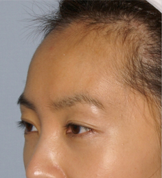 Asian Forehead Reduction - Patient 4 - Obl Left - Before Asian Forehead Reduction - Patient 4 - Obl Left - Before
