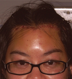 Asian Forehead Reduction - Patient 5 - Front - After Asian Forehead Reduction - Patient 5 - Front - After