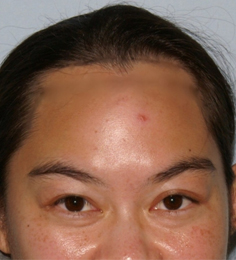 Asian Forehead Reduction - Patient 5 - Front - Before