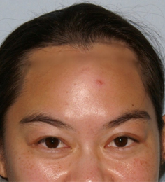 Asian Forehead Reduction - Patient 5 - Front - Before Asian Forehead Reduction - Patient 5 - Front - Before