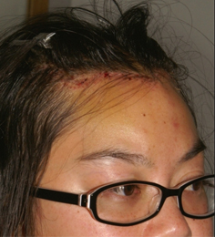 Asian Forehead Reduction - Patient 5 - Obl Right - After Asian Forehead Reduction - Patient 5 - Obl Right - After